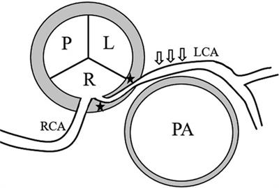 Classification, diagnosis and clinical strategy of congenital coronary artery disease in children